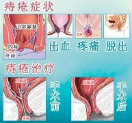 【女性肛肠】新一代HCPT微创手术